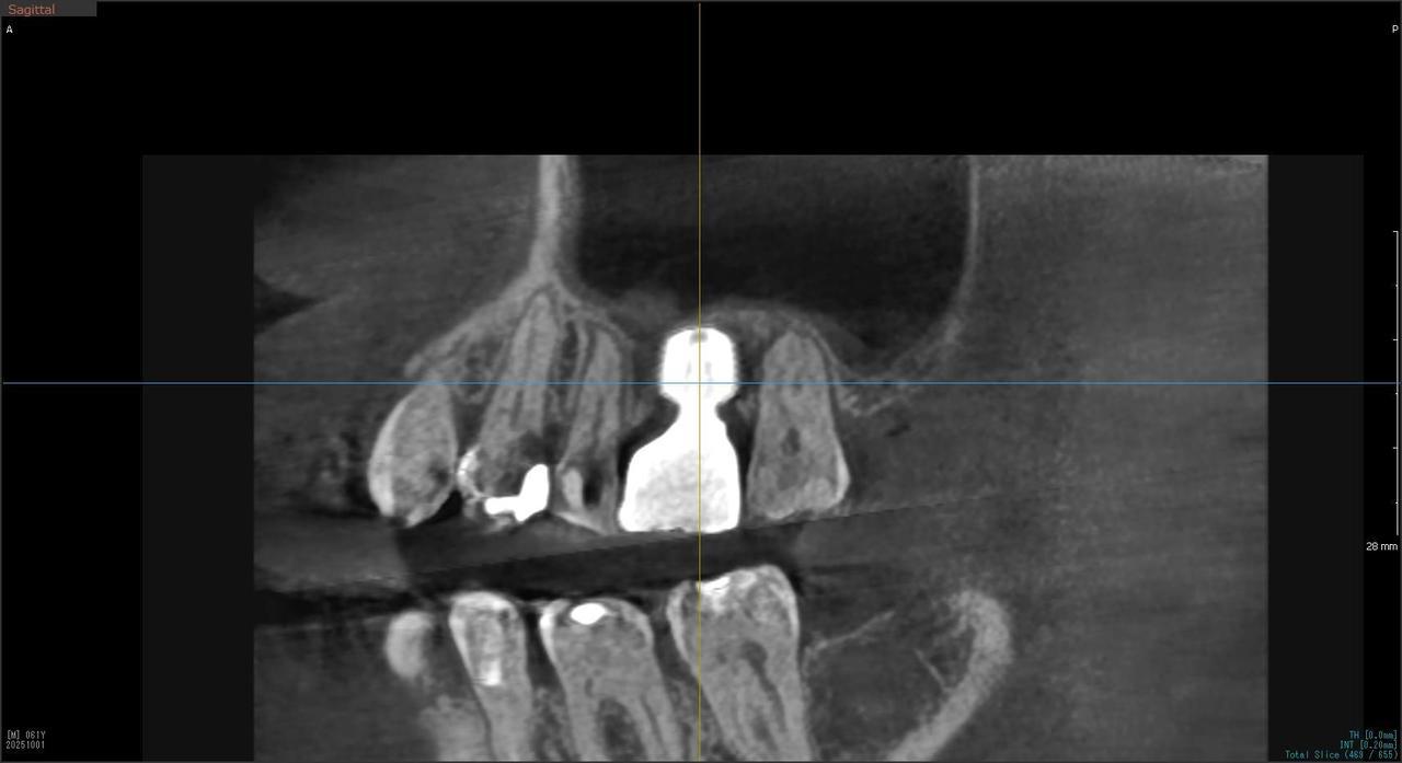 枚方市のインプラントの症例
