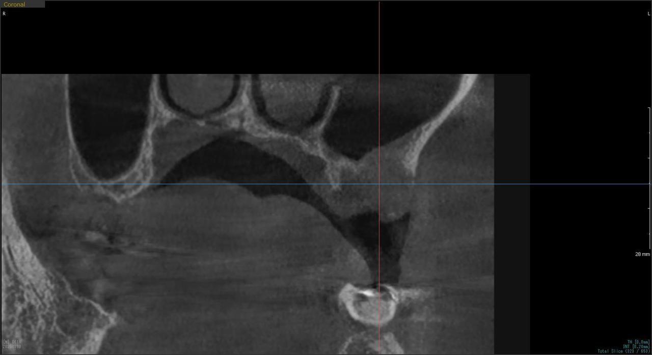 枚方市のインプラントの症例