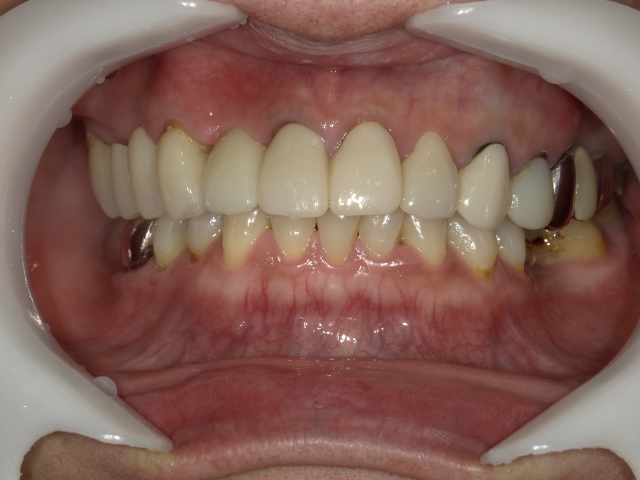 枚方市のインプラントの症例