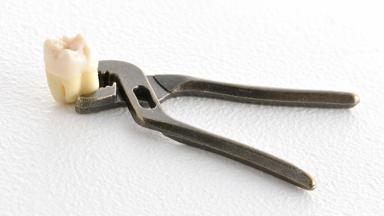 枚方市の親知らずの治療