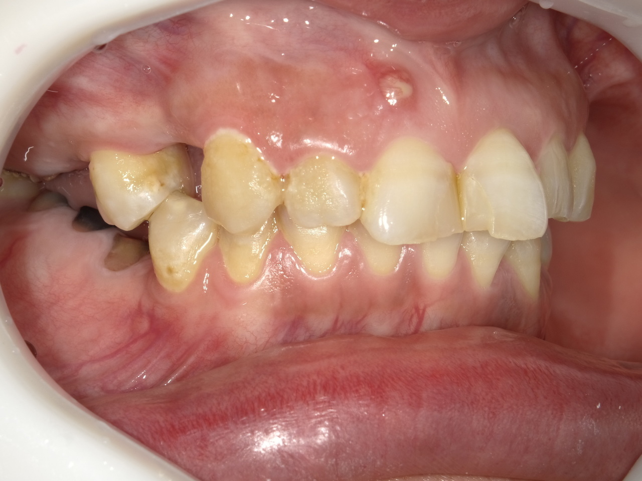 枚方市のインプラントの症例