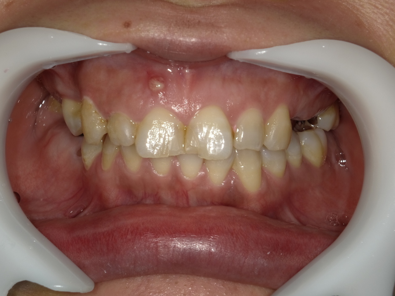 枚方市のインプラントの症例