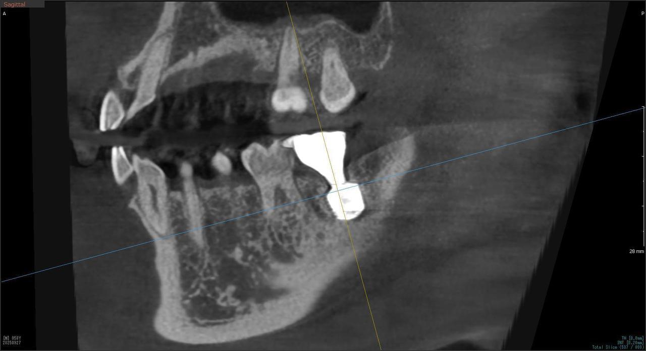 枚方市のインプラントの症例