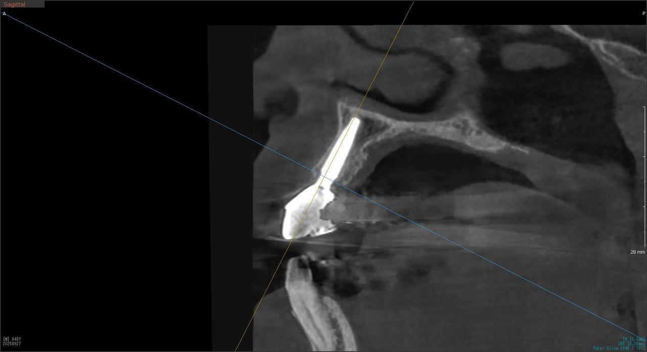 枚方市のインプラントの症例