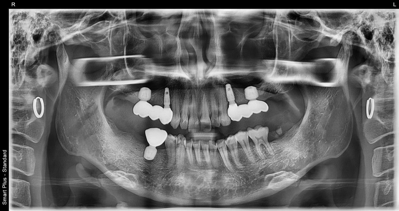 枚方市のインプラントの症例