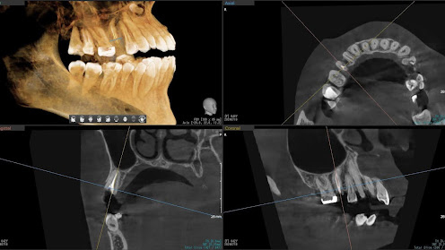 枚方市のインプラントの症例