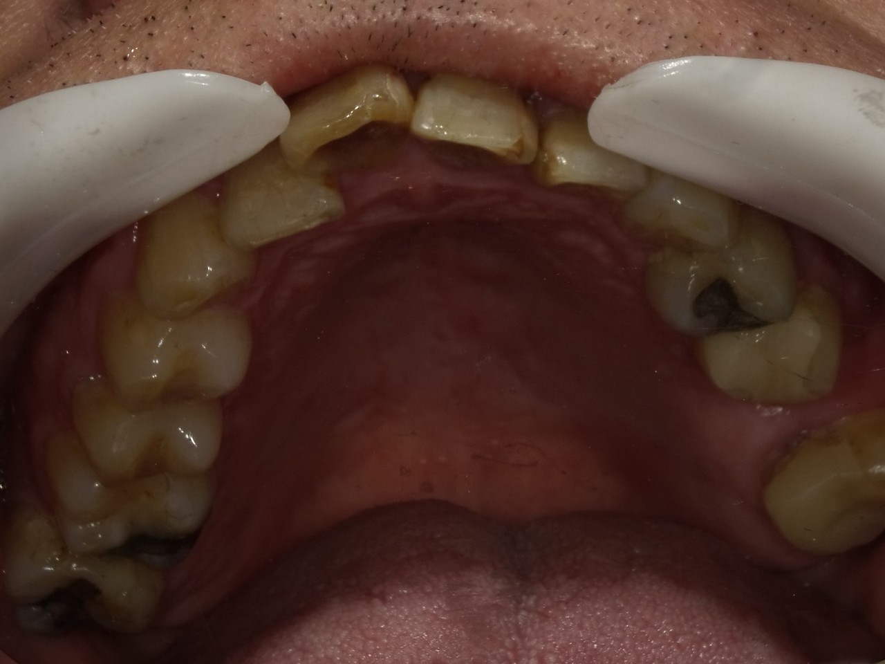 枚方市のインプラントの症例