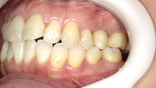 枚方市のインプラントの症例