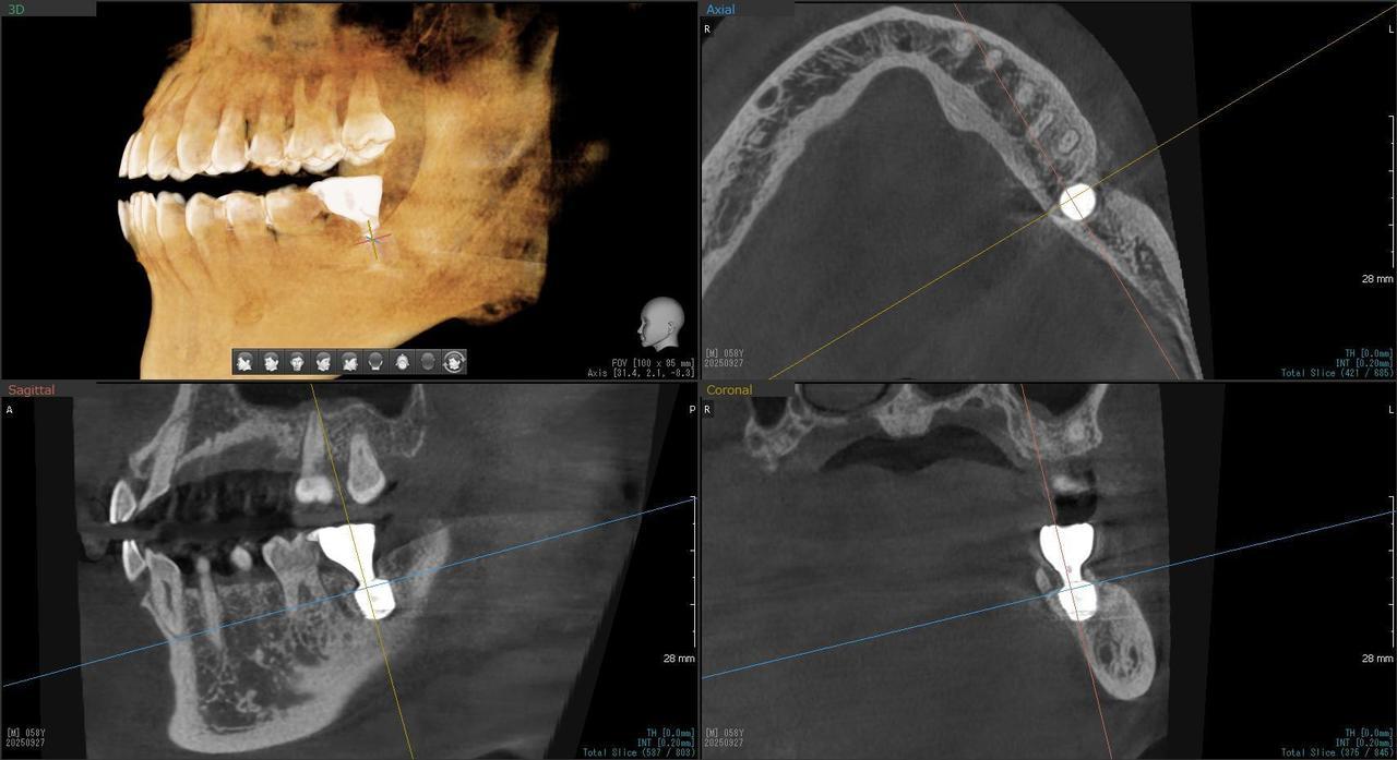 枚方市のインプラントの症例