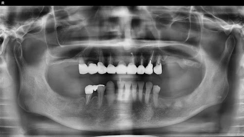 枚方市のインプラントの症例