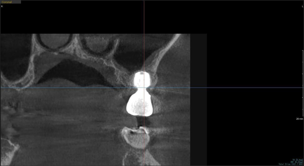 枚方市のインプラントの症例