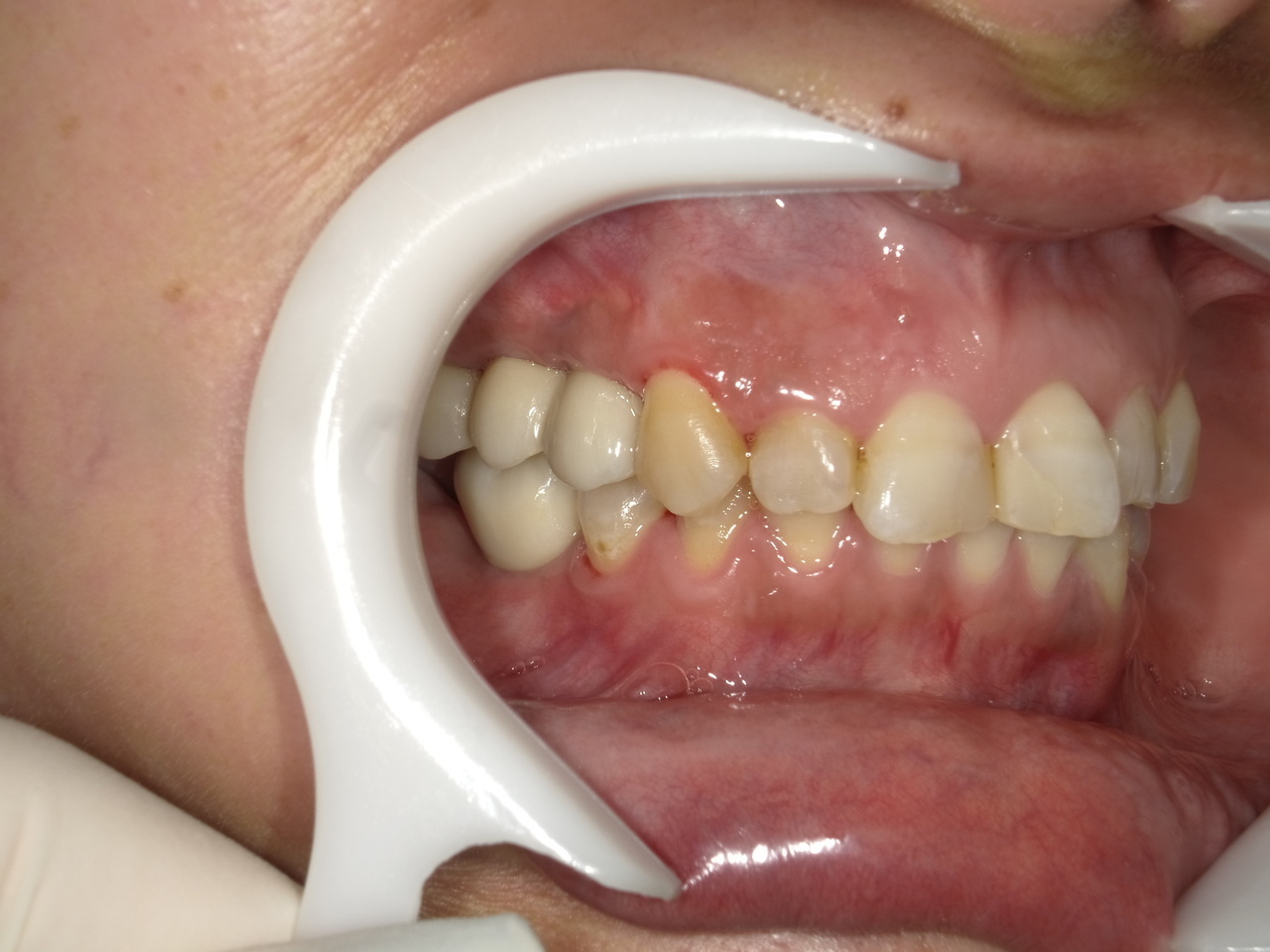 枚方市のインプラントの症例