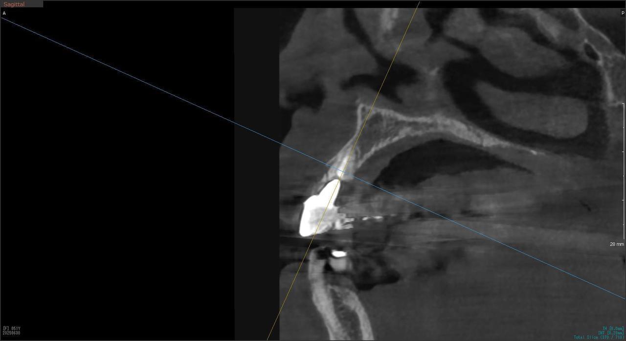 枚方市のインプラントの症例