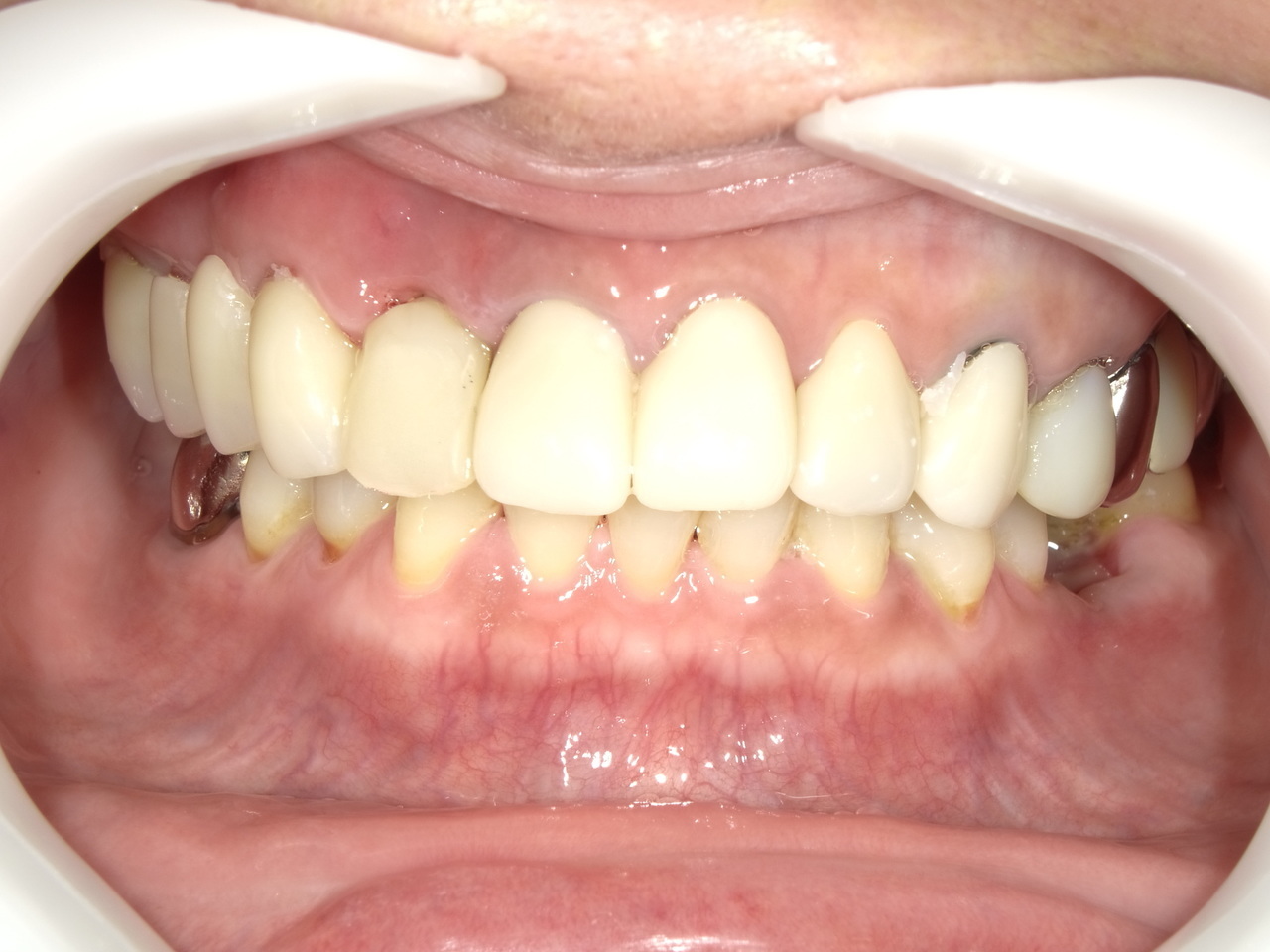 枚方市のインプラントの症例