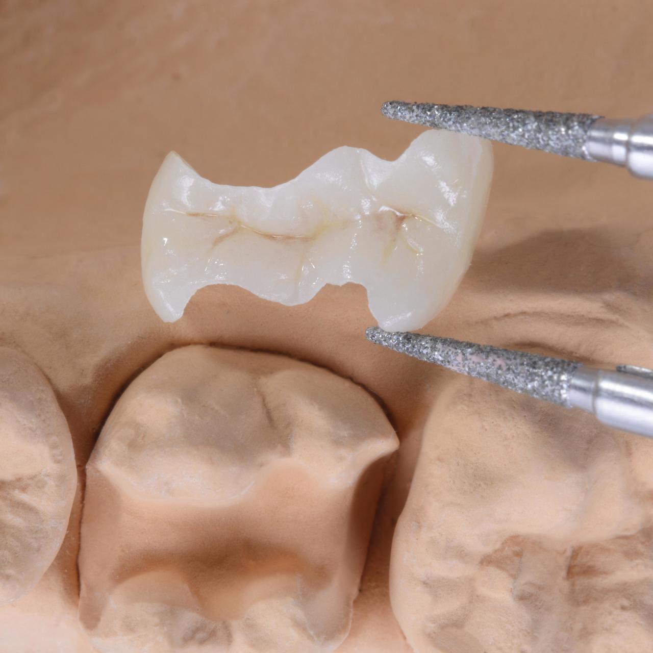 枚方市のメタルフリー治療 