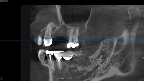 枚方市のインプラントの症例