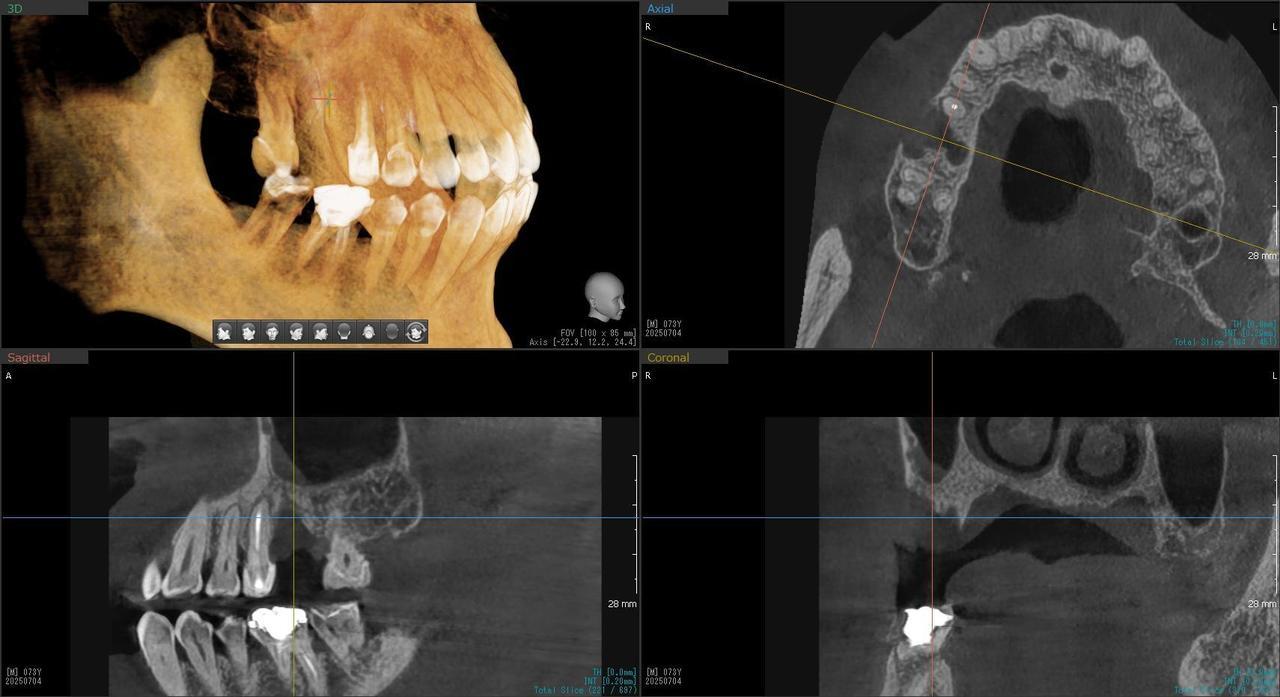 枚方市のインプラントの症例