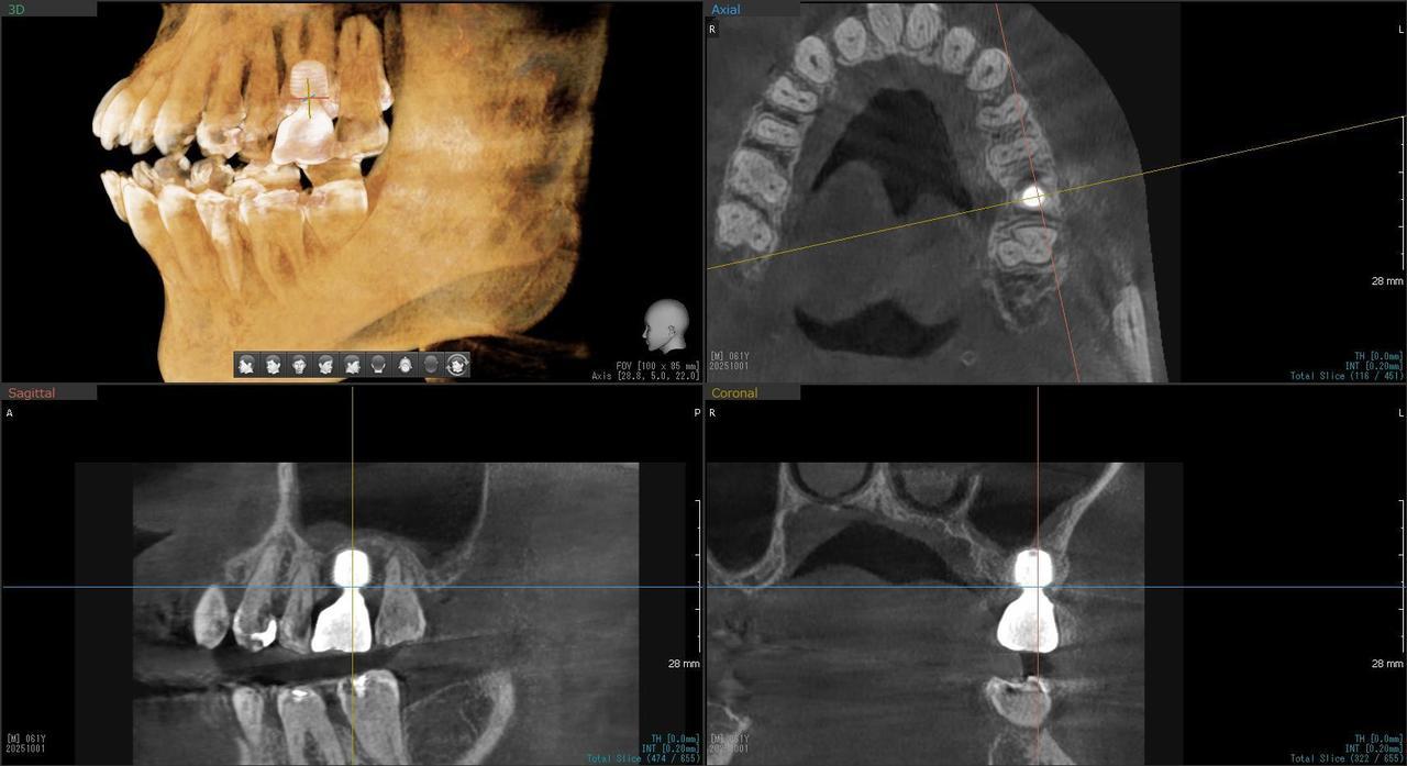 枚方市のインプラントの症例