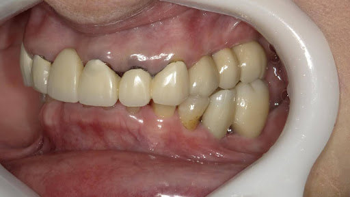 枚方市のインプラントの症例