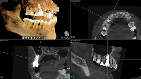 枚方市のインプラントの症例