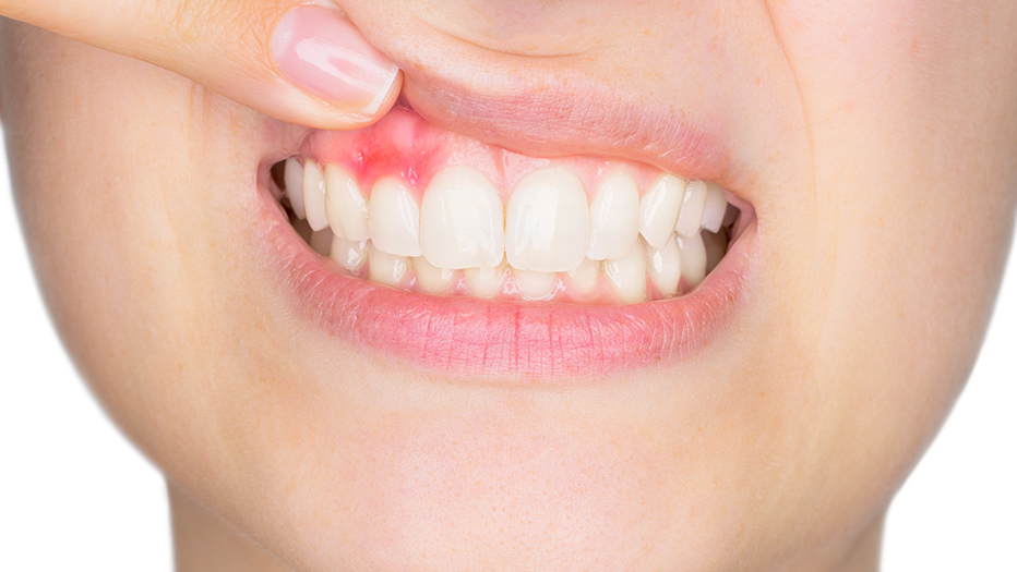 枚方市の歯ぎしりの治療（ナイトガード）