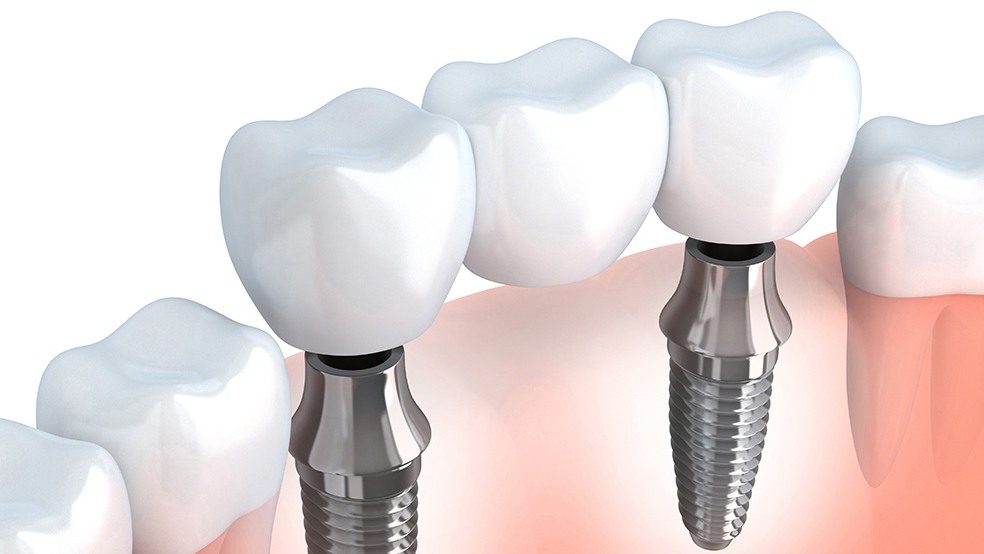 枚方市のインプラントのこだわり