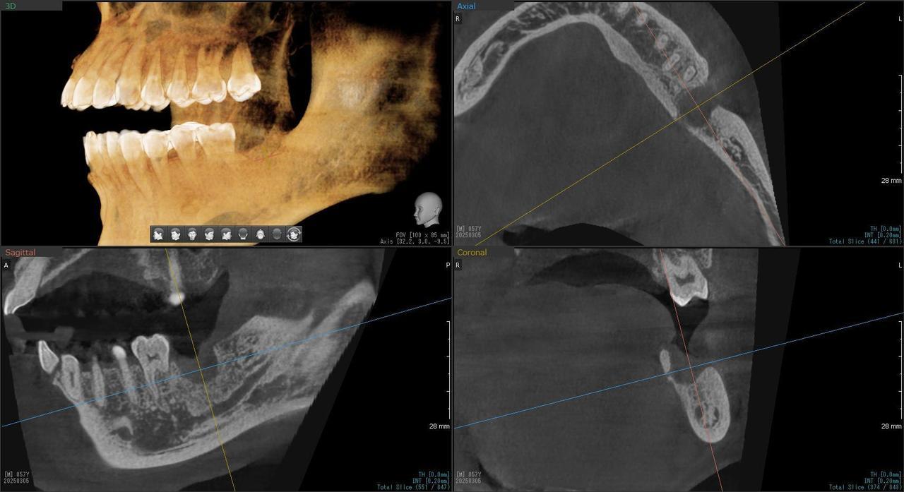 枚方市のインプラントの症例