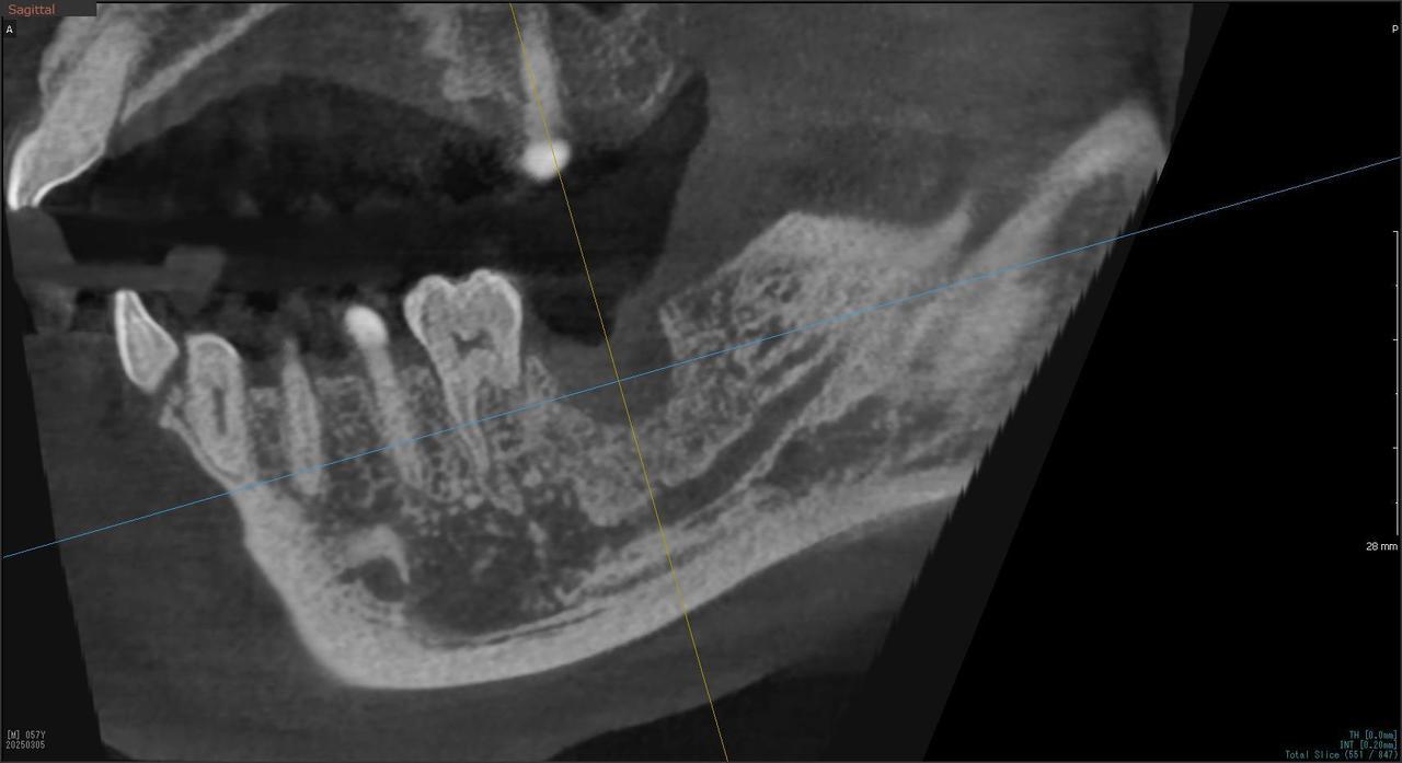 枚方市のインプラントの症例