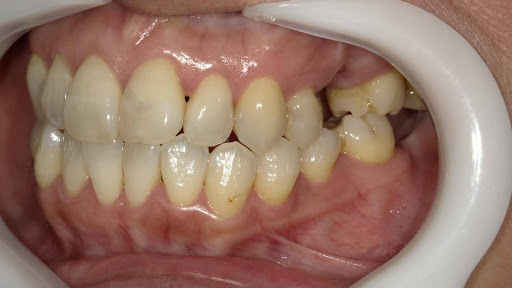 枚方市のインプラントの症例