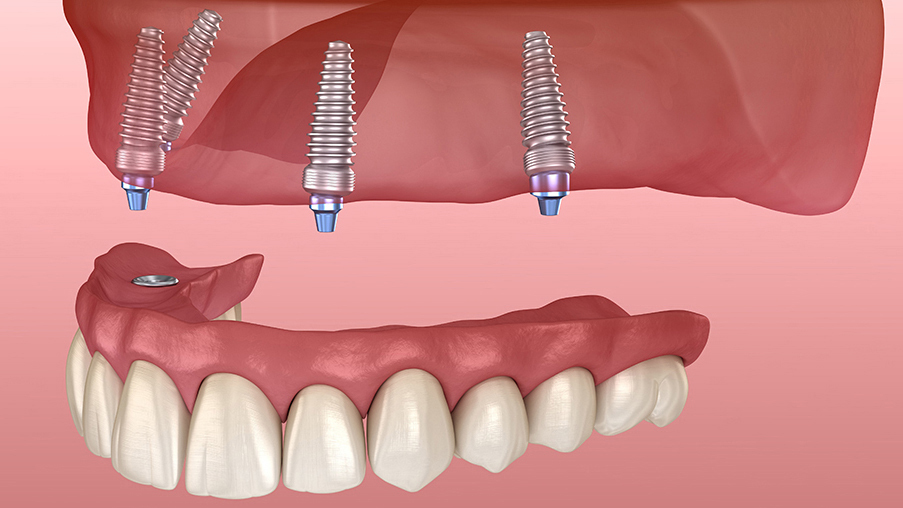 枚方市のオールオン4