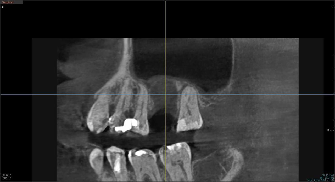 枚方市のインプラントの症例