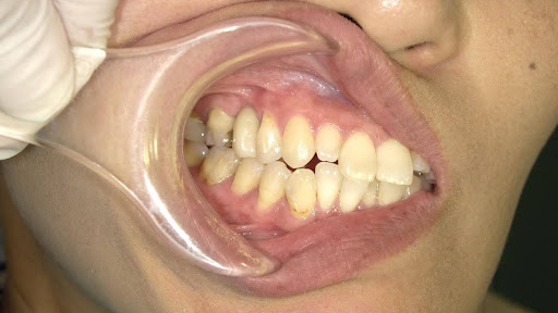 枚方市のインプラントの症例