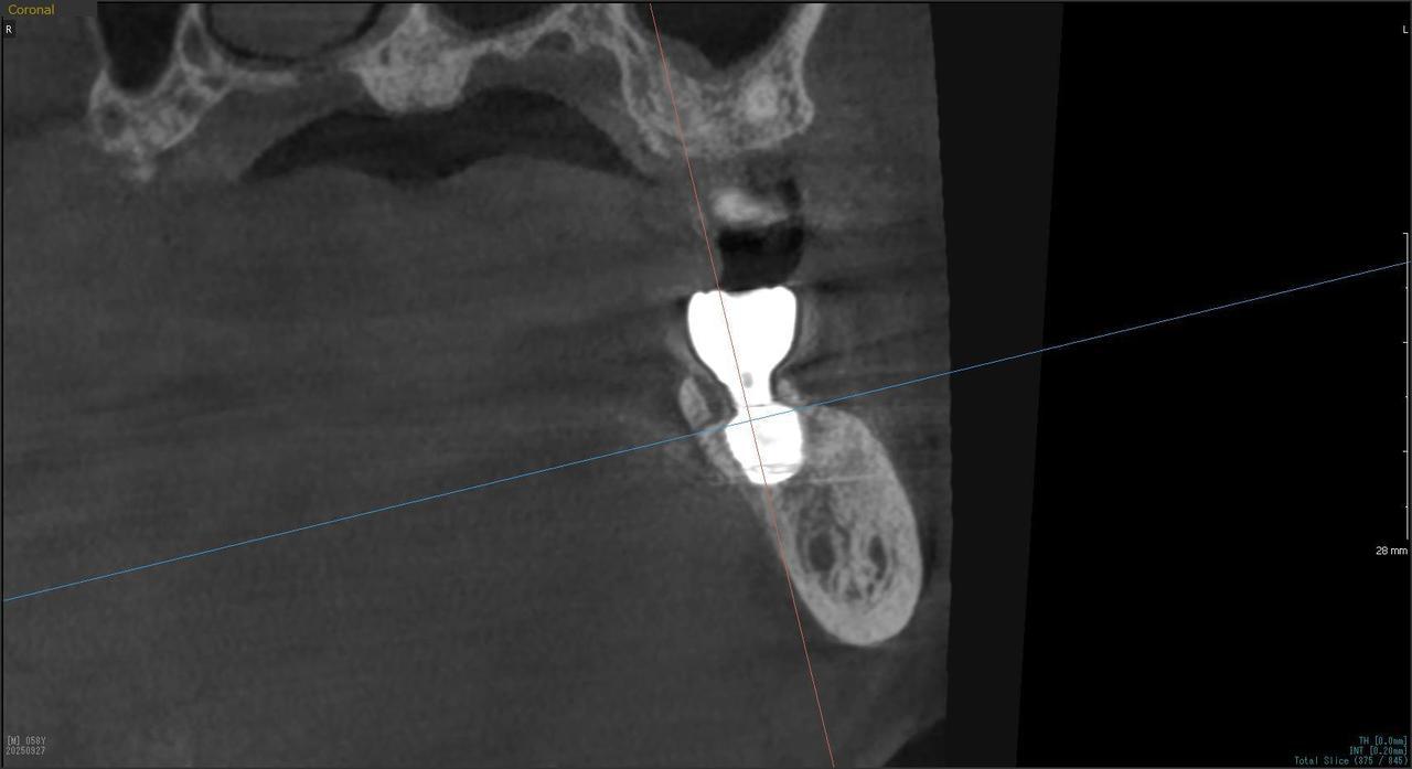 枚方市のインプラントの症例