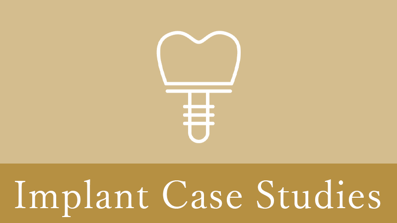 枚方市のインプラントの症例