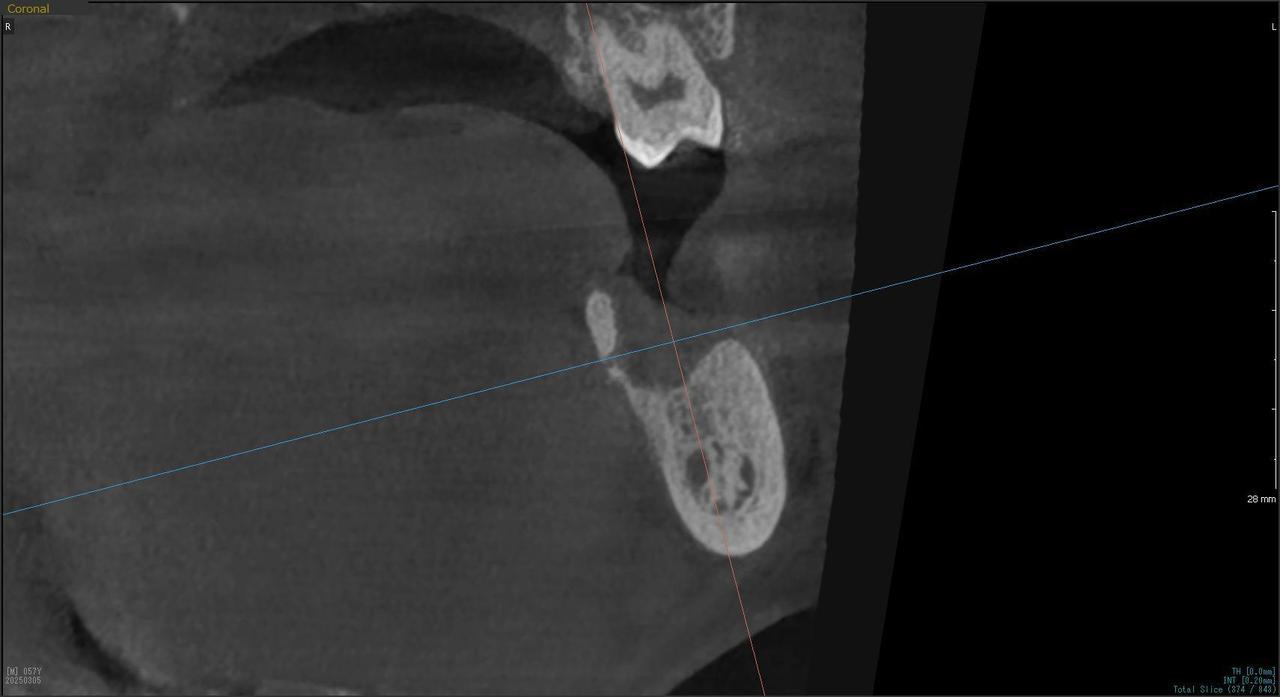 枚方市のインプラントの症例