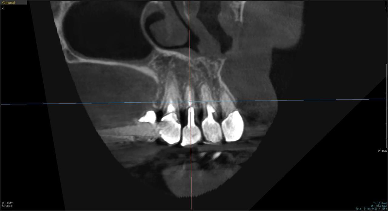 枚方市のインプラントの症例