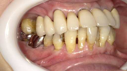 枚方市のインプラントの症例