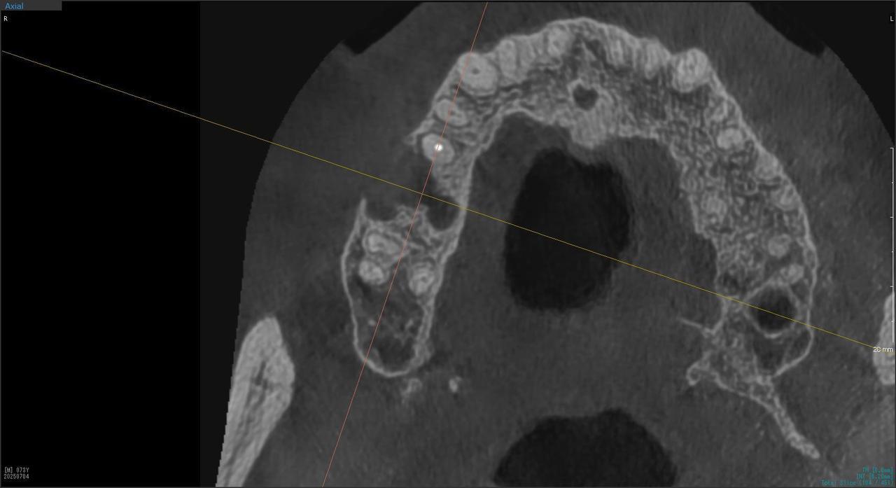 枚方市のインプラントの症例