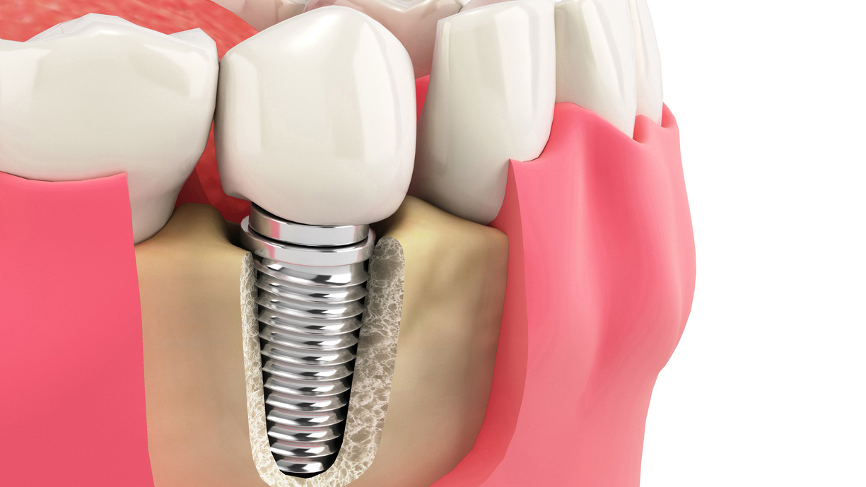 枚方市のインプラント治療