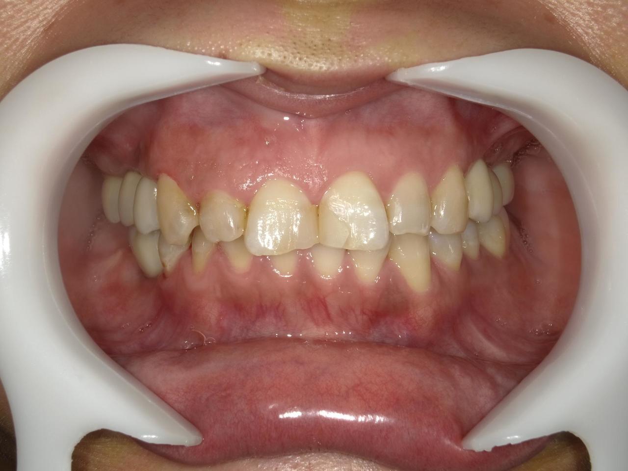 枚方市のインプラントの症例