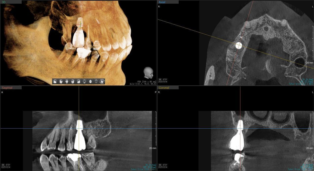 枚方市のインプラントの症例