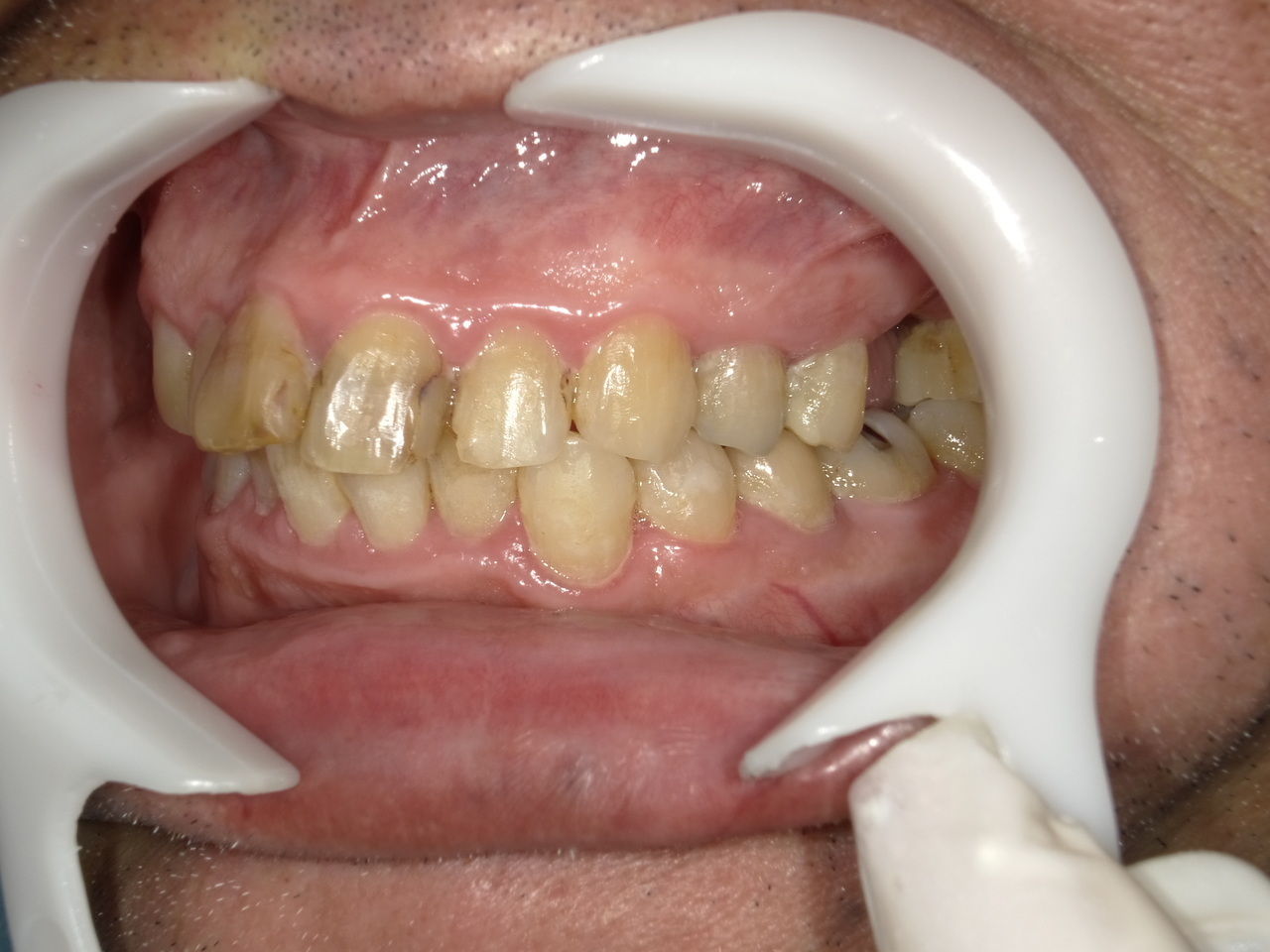 枚方市のインプラントの症例