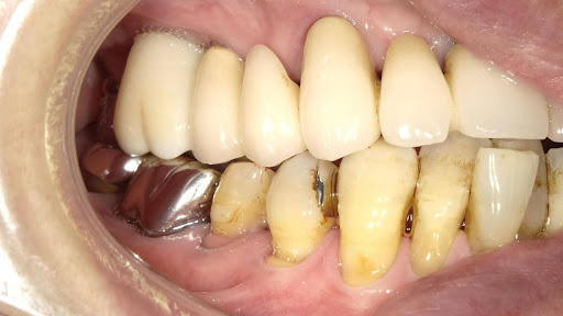 枚方市のインプラントの症例