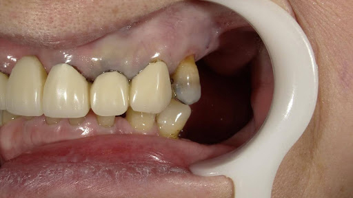枚方市のインプラントの症例