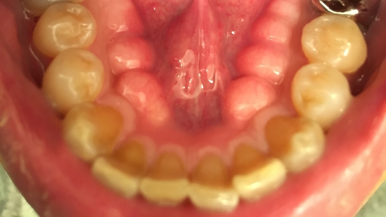 枚方市の歯ぎしりの治療（ナイトガード）
