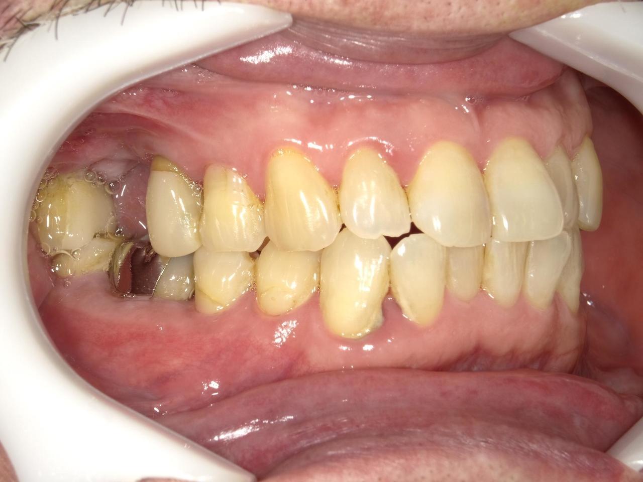 枚方市のインプラントの症例
