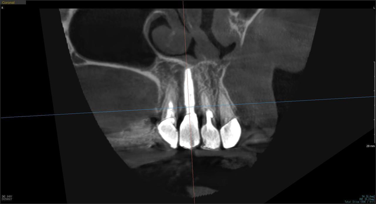 枚方市のインプラントの症例