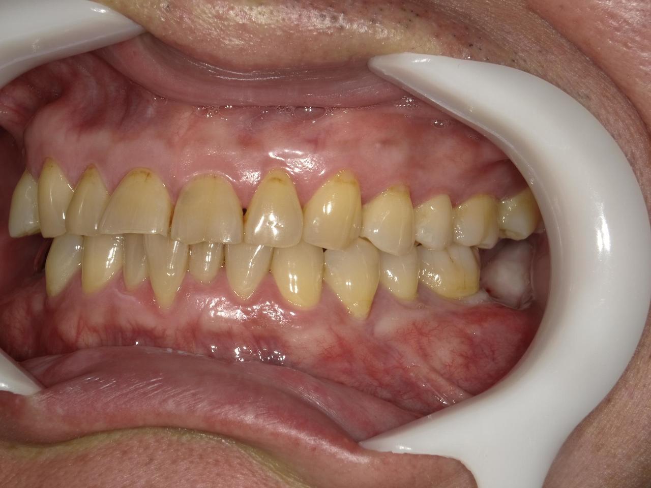 枚方市のインプラントの症例