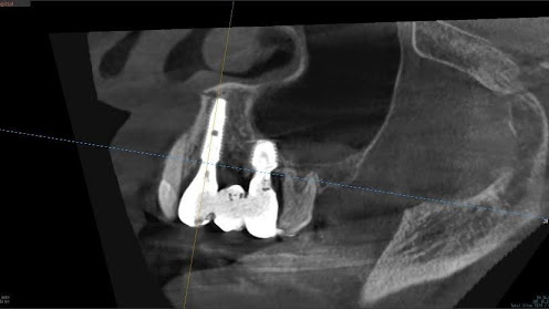 枚方市のインプラントの症例