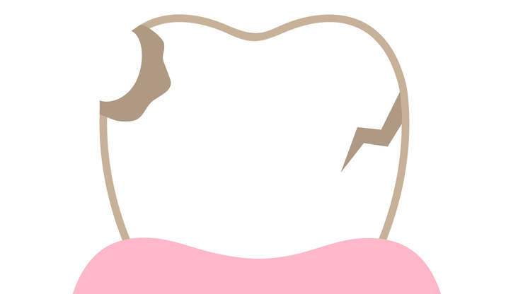 枚方市の歯ぎしりの治療（ナイトガード）